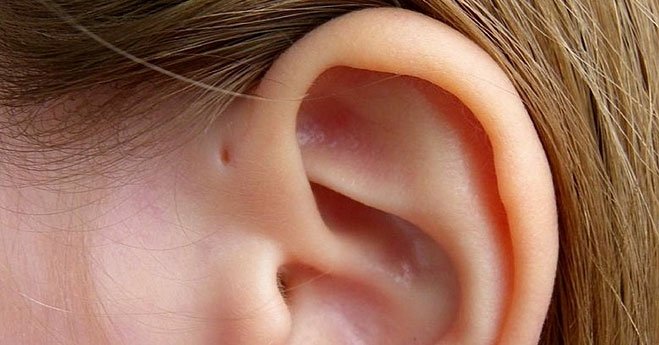 Lỗ nhỏ trên vành tai là đặc điểm di truyền rất ít người sở hữu.