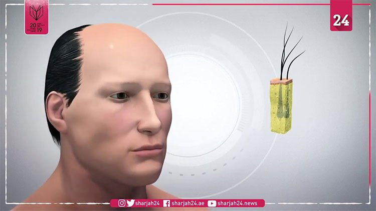 Điều trị hói đầu nhờ công nghệ in 3D