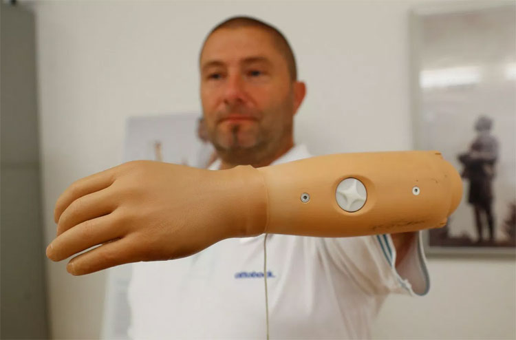Edmund Rath có thể điều khiển cánh tay sinh học bằng tín hiệu từ não bộ.