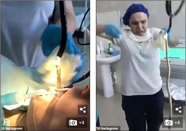 Con rắn được kéo ra từ họng của nữ bệnh nhân Nga