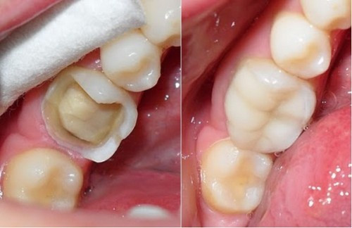 Tác động của việc nghiến răng sẽ xảy ra từ từ.