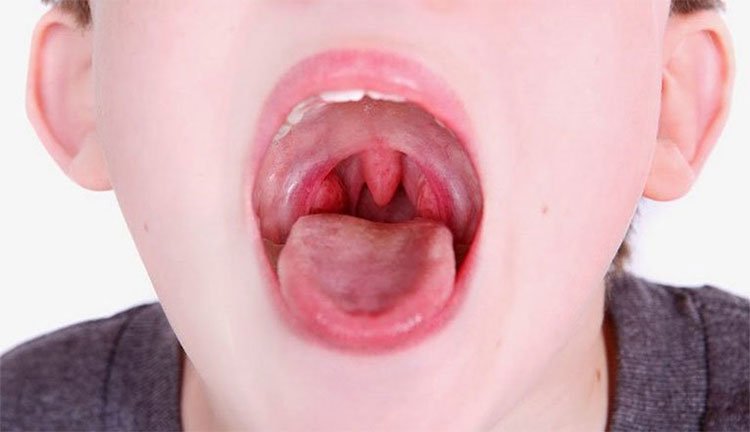 Viêm họng hạt