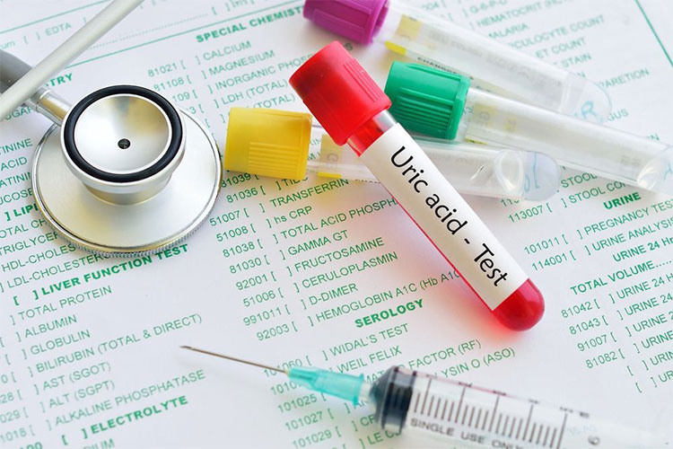 Bác sĩ có thể yêu cầu lấy mẫu nước tiểu 24 giờ nếu thấy nồng độ axit uric tăng cao trong máu của bạn.