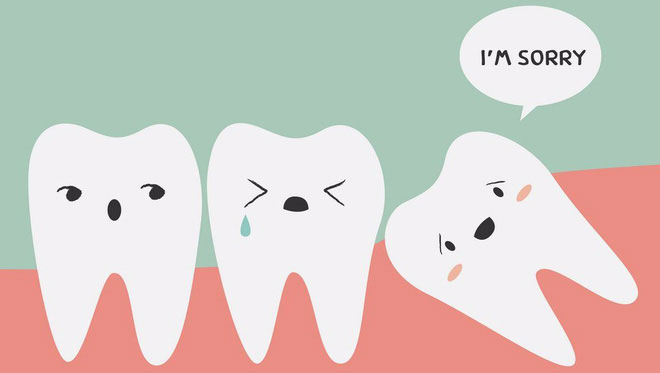 Những chiếc răng khôn thường mọc ngầm, bị lệch lạc vì thiếu chỗ.