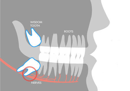 Ở nhiều nền văn hóa khác, răng khôn cũng có nét độc đáo.