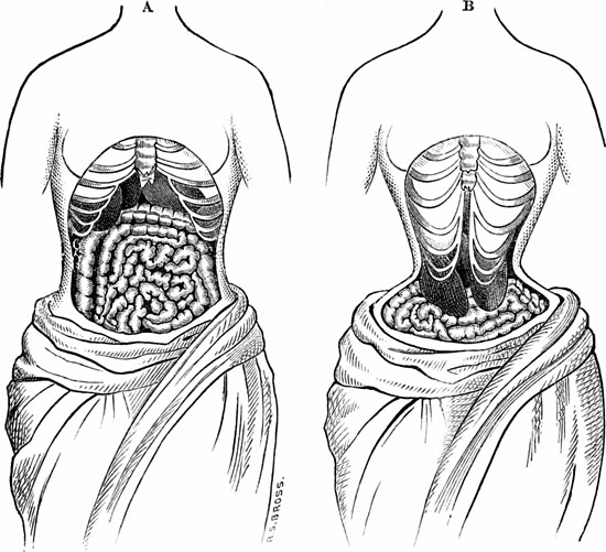 Mặc áo nịt bụng có thể khiến nội tạng bị lệch khỏi vị trí ban đầu.
