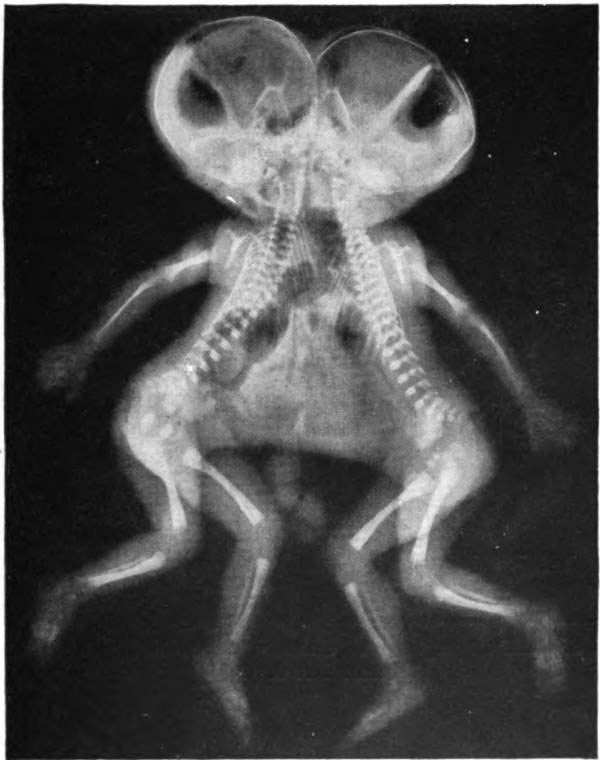 Hình ảnh chụp X-quang của cặp song sinh dính liền vào năm 1954.
