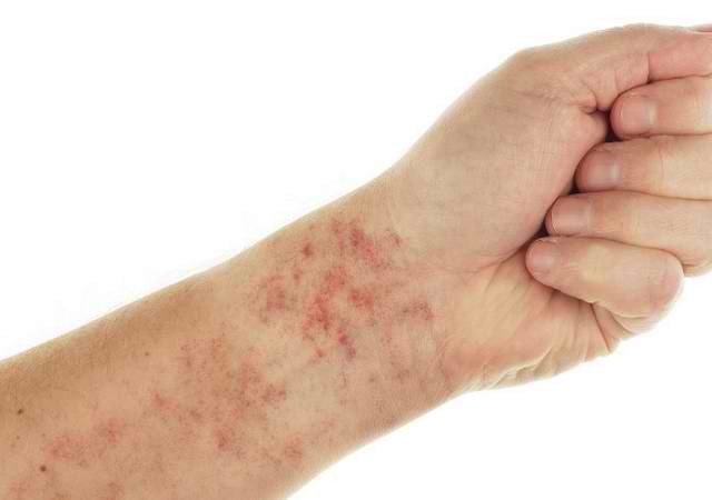 Bệnh nhân lupus nổi các chấm đỏ trên da do mạch máu bị rò rỉ. 
