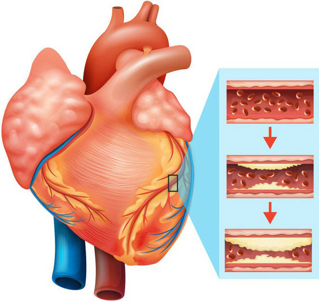 Thực phẩm chiên rán ảnh hưởng không tốt tới sức khỏe tim mạch.
