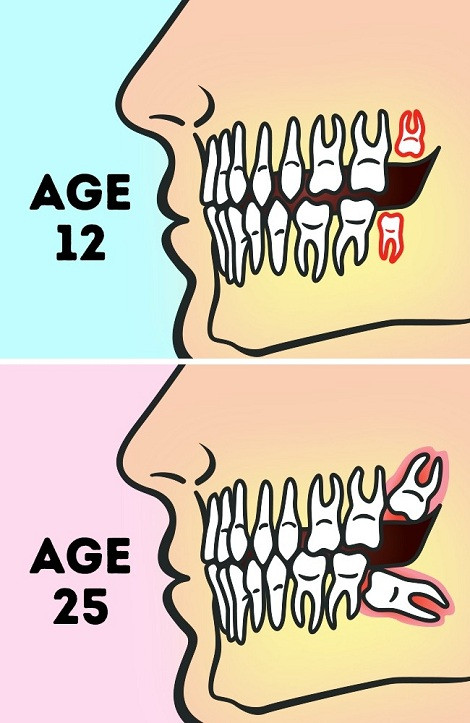 Vị trí của răng khôn ở tuổi 12 và tuổi 25 trong trường hợp không nhú lên được.
