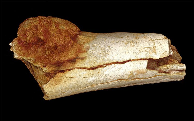 Xương chân Australopithecus sediba bị ảnh hưởng bởi Osteosarcoma.