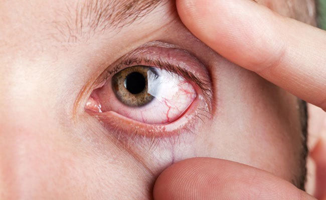 Chớp mắt nhiều để tiết nước mắt cũng giúp mắt đỡ khô tạm thời.