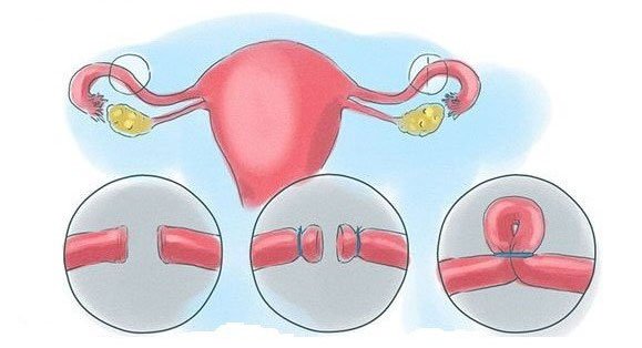 Thắt ống dẫn trứng để trứng không thể di chuyển vào tử cung.