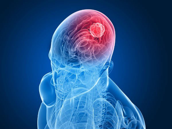Triệu chứng của ung thư não phụ thưộc chủ yếu vào kích thước và vị trí của khối u trong não. 