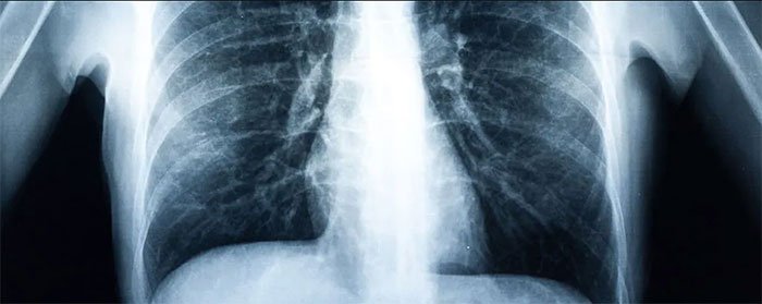 Có một số lượng lớn các khu vực bị viêm và sẹo cùng với nhiều đốm mô chết trong phổi khi hút vape.