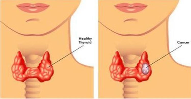 Triệu chứng của ung thư vòm họng thường mơ hồ.