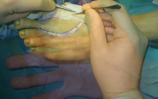 Phẫu thuật chuyển ngón chân cái thành ngón tay cái