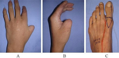 Ngón chân cái (C) sẽ được thu nhỏ và ghép vào vị trí ngón tay cái chỉ trong một lần phẫu thuật.