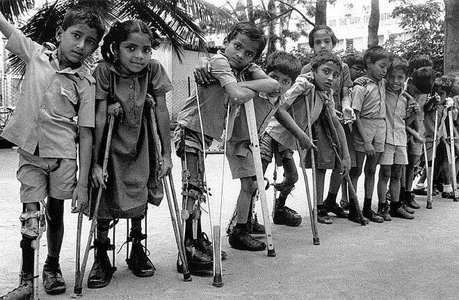Trẻ em mắc bệnh bại liệt đầu thế kỷ 20.