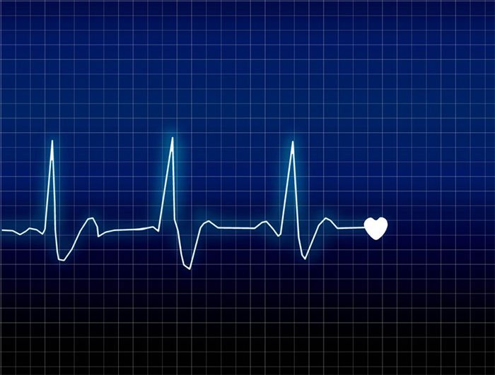 Có rất nhiều nguyên nhân dẫn đến tình trạng rối loạn nhịp tim.