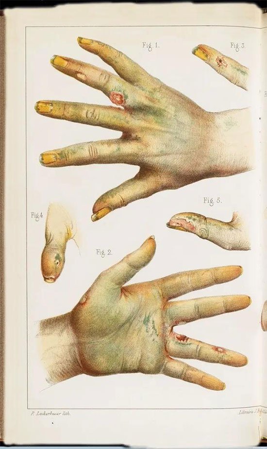 Người bị ngộ độc asen mãn tính cũng sẽ bị rụng tóc rất nhiều và có những đường trắng trên móng tay.