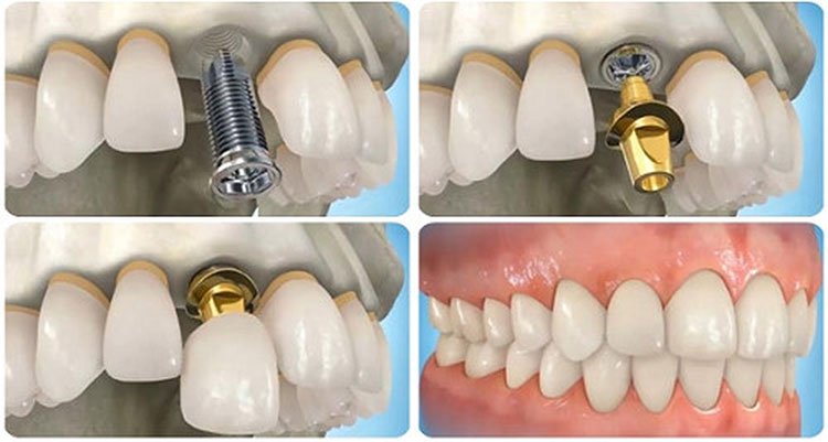 Tạo hình răng Implant giống như răng thật.