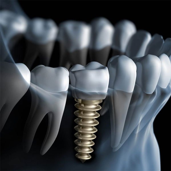 Trụ Implant càng tốt và chất lượng cao thì hiệu quả phục hình càng lâu bền.