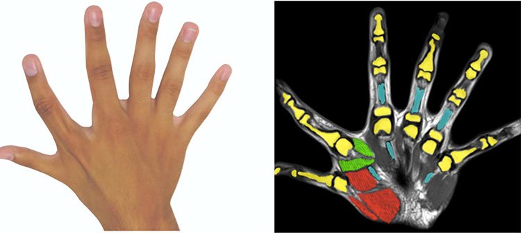 Những người có 6 ngón tay được đánh giá có xu hướng “khéo tay” hơn bình thường.