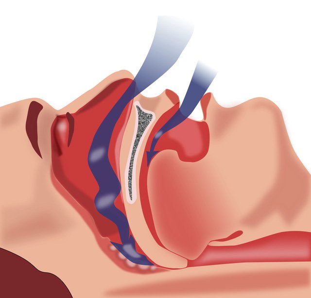Ngưng thở khi ngủ gây ra bởi các mô mềm phía sau họng chặn đường thở