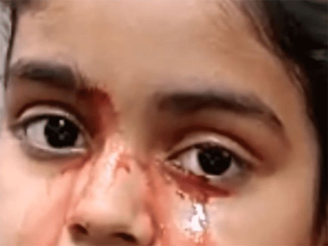 Bé gái 11 tuổi ở Ấn Độ vẫn chưa được tìm ra nguyên nhân vì sao mắc tình trạng khóc ra máu.