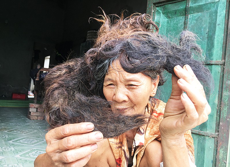 Người phụ nữ có mái tóc kì dị: Kết thành nhiều mảng, cứ cắt là đổ bệnh