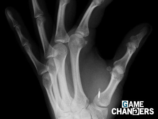 Hình ảnh X-quang của một bàn tay với một microchip được cấy vào giữa ngón cái và ngón trỏ.