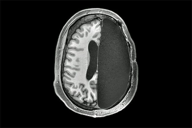 Não bộ có thể thích nghi và hoạt động sau phẫu thuật cắt bán cầu.