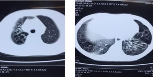 Hình ảnh chụp cắt lớp vi tính lồng ngực của bệnh nhân trước khi ghép phổi.