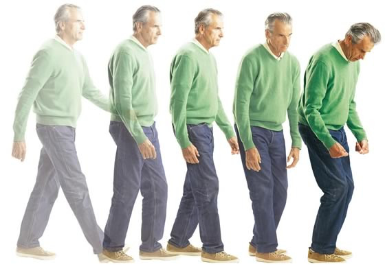Bệnh Parkinson thường gặp ở người lớn tuổi, chỉ 10% trường hợp khởi phát tuổi dưới 40. 
