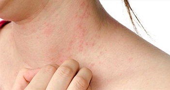 Vì sao bạn hay bị ngứa khi trời lạnh? Vì sao bạn hay bị ngứa khi trời lạnh?