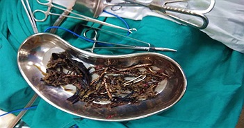 Hãi hùng 1,5kg kim loại được tìm thấy trong dạ dày một người phụ nữ Hãi hùng 1,5kg kim loại được tìm thấy trong dạ dày một người phụ nữ