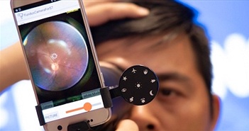 Kiểm tra mắt bị thoái hóa điểm vàng: Samsung tìm ra cách đo nhanh và chính xác